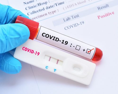 Com 33 pacientes internados, PB registra mais 760 novos casos de Covid-19 e um óbito